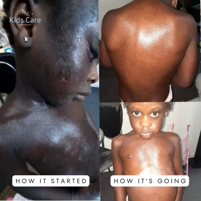 eruption set treatment for Eela